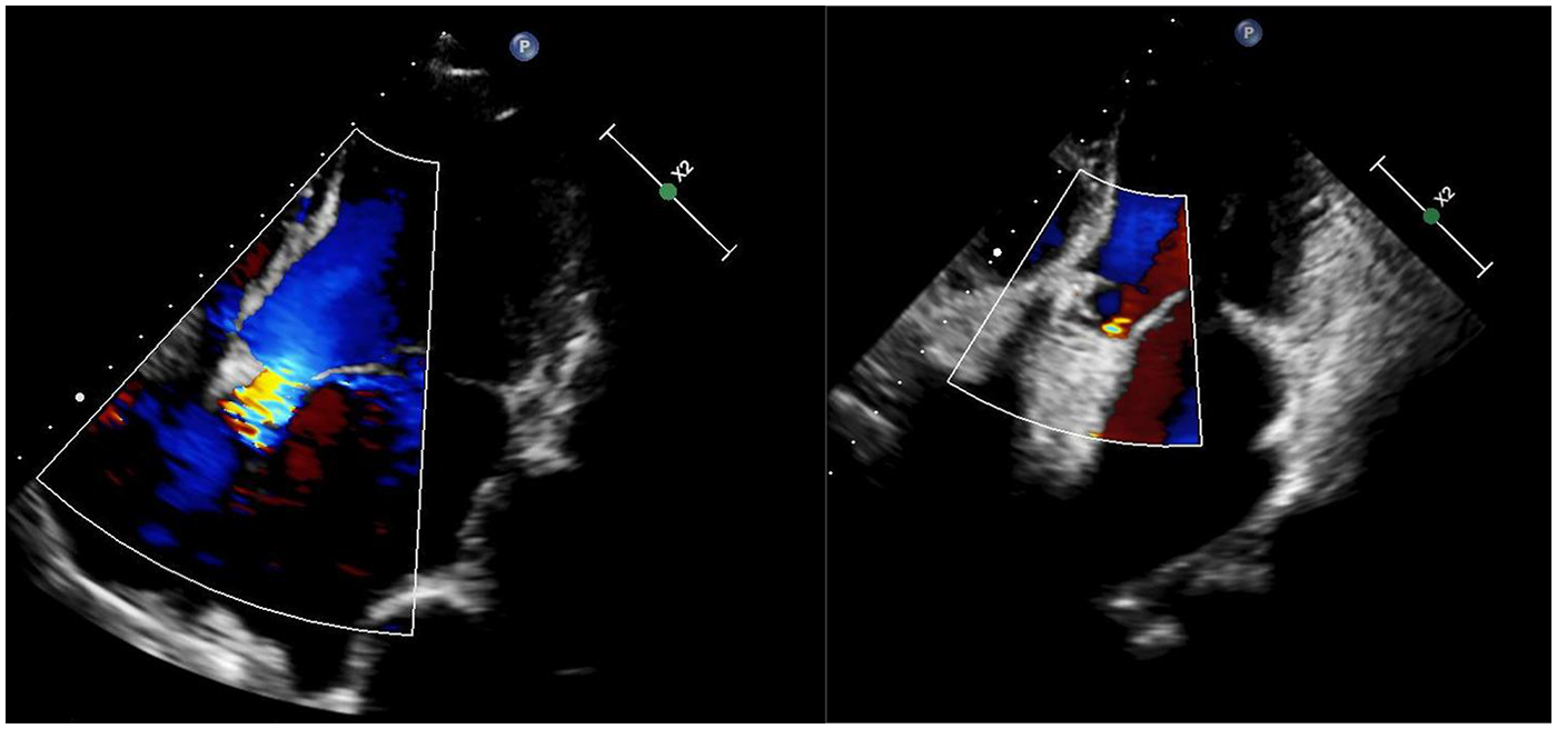 Two Doppler ultrasound images display heart activity with blood flow in color. The left image shows a more pronounced blue and red flow pattern, while the right image has a similar pattern with slight variations. Both images depict heart structures in grayscale.