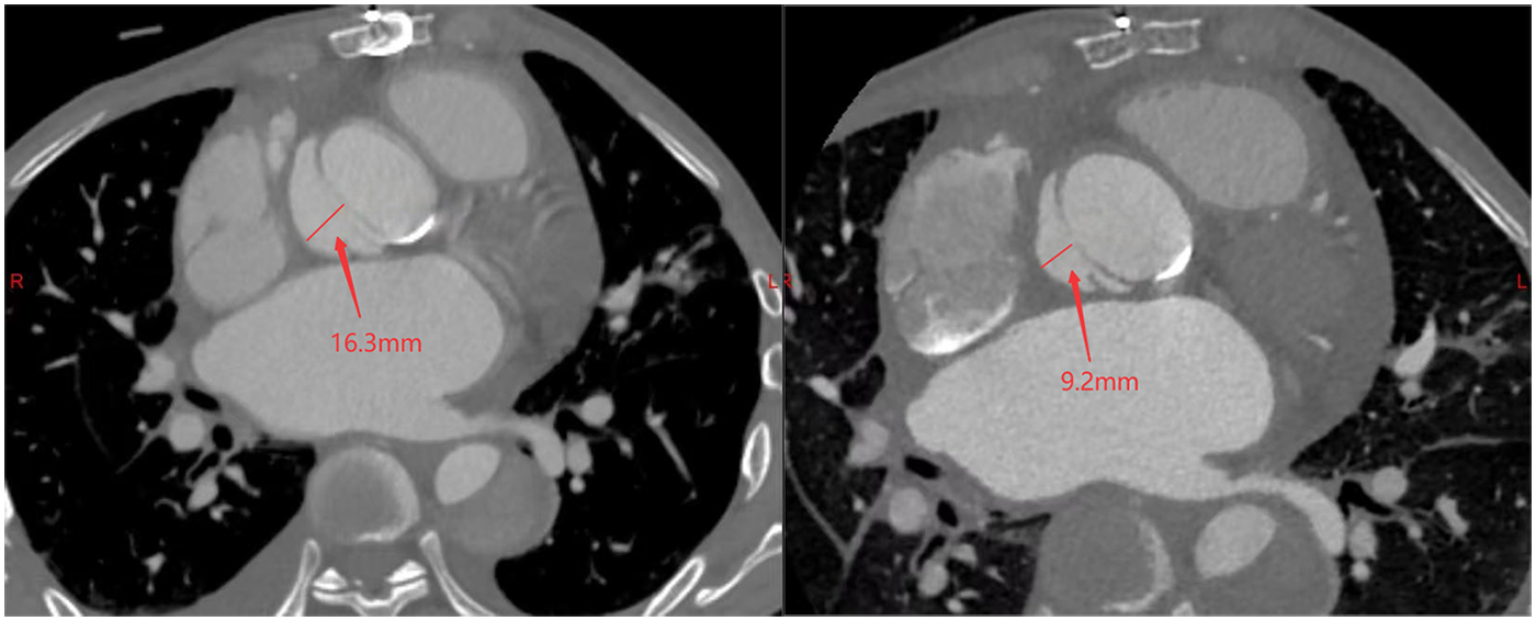CT scans of the chest show cross-sectional images of the heart and surrounding structures. The left image highlights a measurement of 16.3 millimeters indicated by a red arrow, while the right image features a measurement of 9.2 millimeters, also highlighted by a red arrow. The scans display variations in tissue density with high contrast between the lungs and other structures.