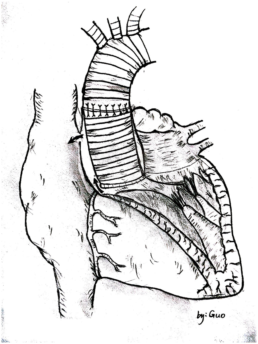 Illustration of a human heart with a focus on the aorta, depicted with detailed lines and stitching patterns. The image is drawn in black and white, with text in the bottom right corner reading \"by: Guo.\"