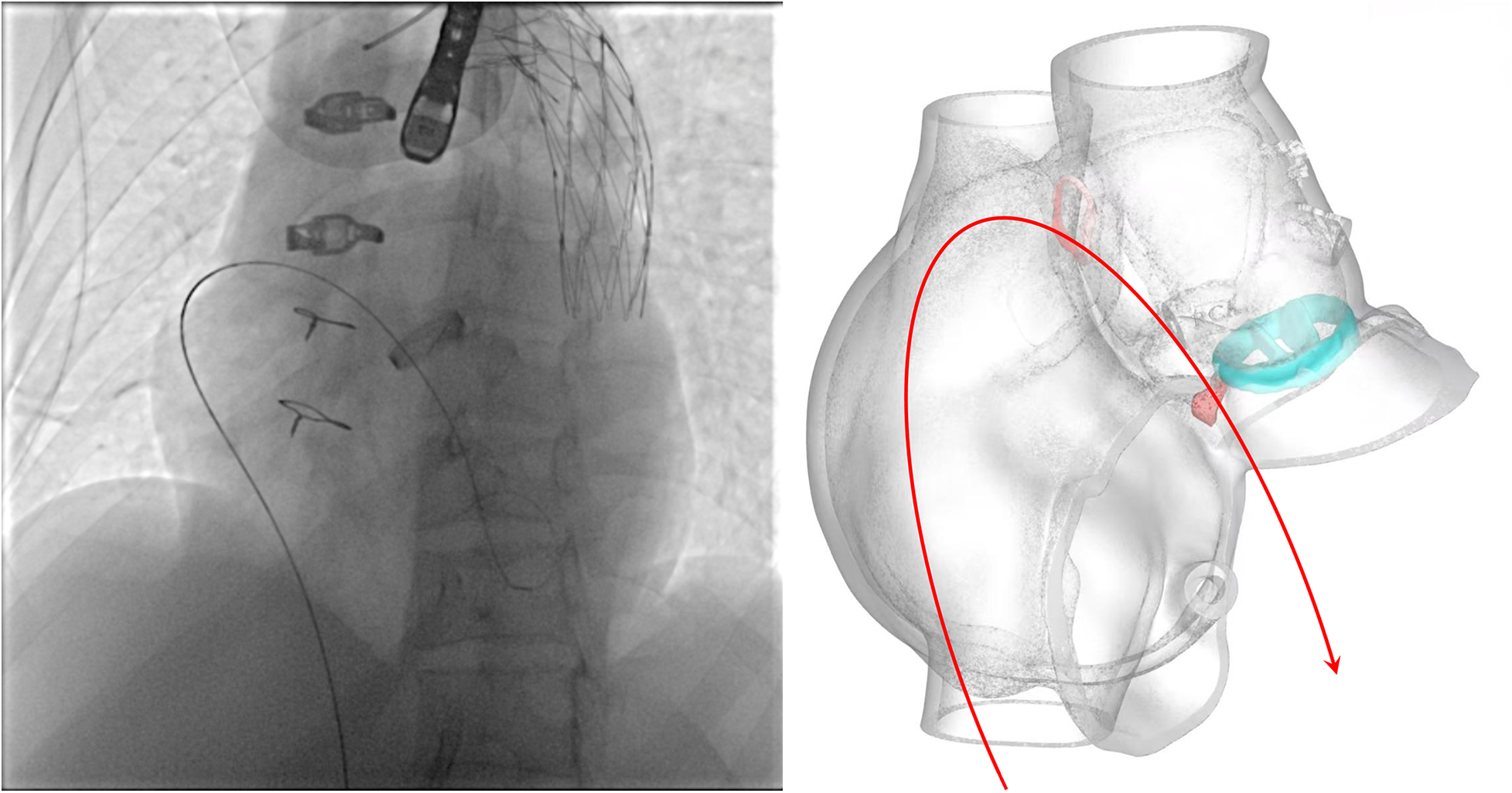 On the left, a fluoroscopic image shows a catheter navigating through a stented blood vessel. On the right, a 3D anatomical model illustrates the heart with highlighted regions, including a blue area representing the pulmonary artery. A red line traces the catheter's route from the vessel to the heart.