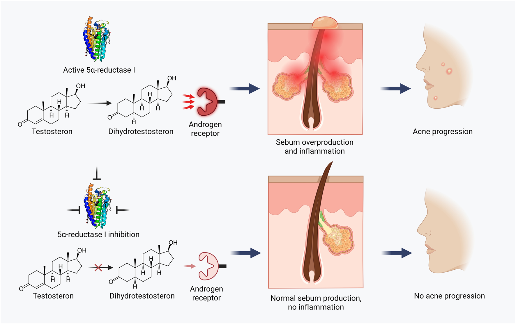 Diagram showing the role of 5α-reductase in acne progression. The top sequence illustrates active 5α-reductase converting testosterone into dihydrotestosterone, leading to sebum overproduction, inflammation, and acne progression. The bottom sequence shows inhibition of 5α-reductase, resulting in normal sebum production, no inflammation, and no acne progression.