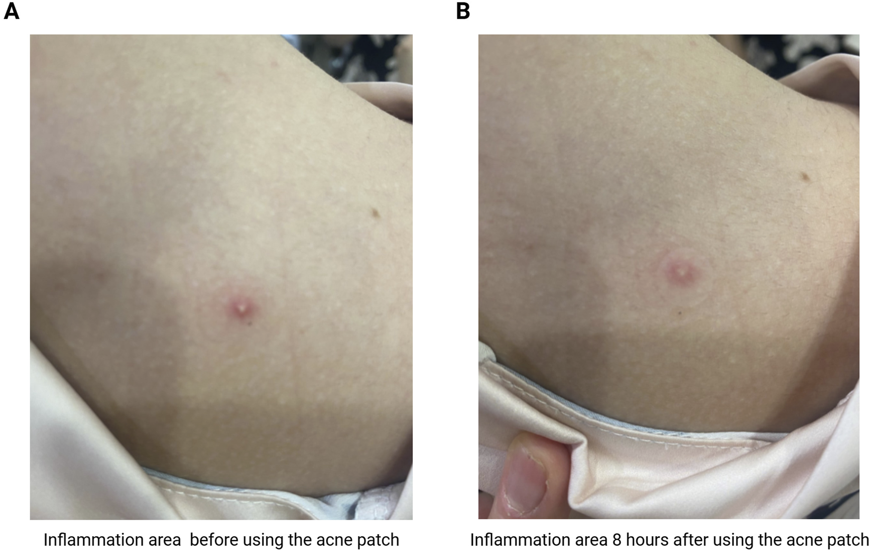 Comparison of skin inflammation before and after using an acne patch in clinical research. Image A shows a red, inflamed bump on the skin of volunteers. Image B, taken eight hours later, shows significantly reduced redness and inflammation at the same spot.