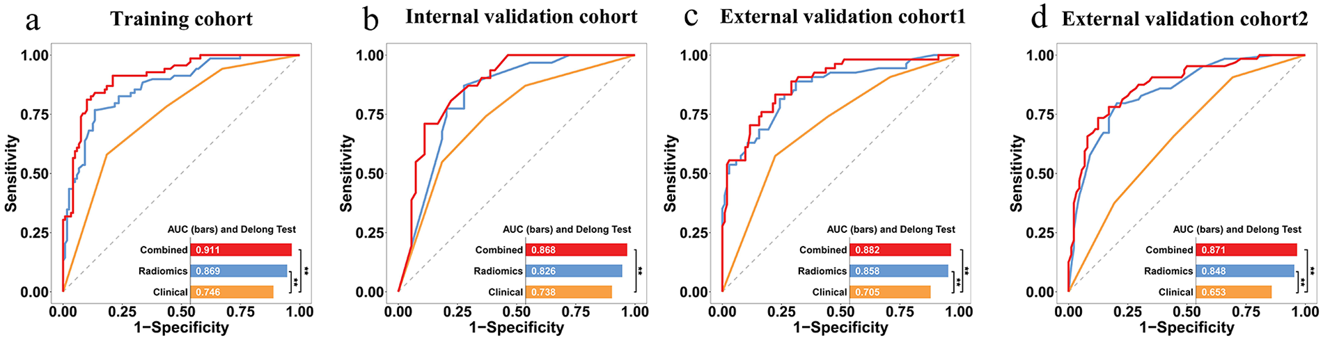 Four ROC curve charts compare the performance of Combined, Radiomics, and Clinical models across different cohorts: Training, Internal Validation, External Validation 1, and External Validation 2. Each chart shows sensitivity versus 1-specificity, with AUC values. Combined model consistently achieves the highest AUC, followed by Radiomics and Clinical. The Training cohort AUCs: Combined 0.911, Radiomics 0.869, Clinical 0.746. Internal Validation cohort AUCs: Combined 0.868, Radiomics 0.826, Clinical 0.738. External Validation 1 cohort AUCs: Combined 0.882, Radiomics 0.858, Clinical 0.705. External Validation 2 cohort AUCs: Combined 0.871, Radiomics 0.848, Clinical 0.653.