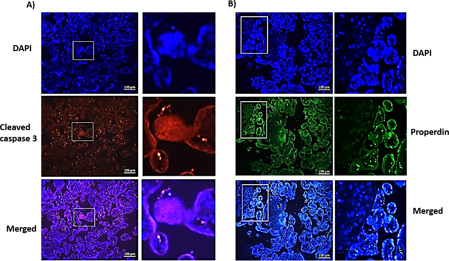 Panel A shows fluorescence microscopy images with DAPI staining in blue and cleaved caspase 3 in red. The merged image combines both stains. Panel B shows DAPI in blue and properdin in green, with a merged image combining these stains. Both panels include enlarged sections highlighted with white boxes, with scale bars marked at one hundred micrometers.