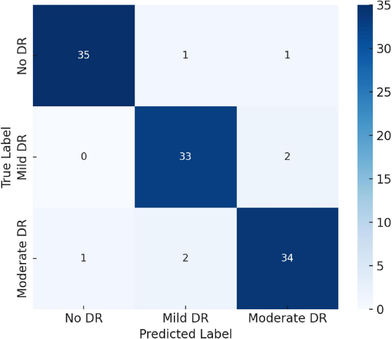 Confusion matrix for diabetic retinopathy classification. Rows represent true labels: No DR, Mild DR, Moderate DR. Columns show predicted labels. Most predictions are accurate, with values 35, 33, and 34 on the diagonal. Mistakes occur as off-diagonal values in smaller numbers. Color intensity indicates prediction count.