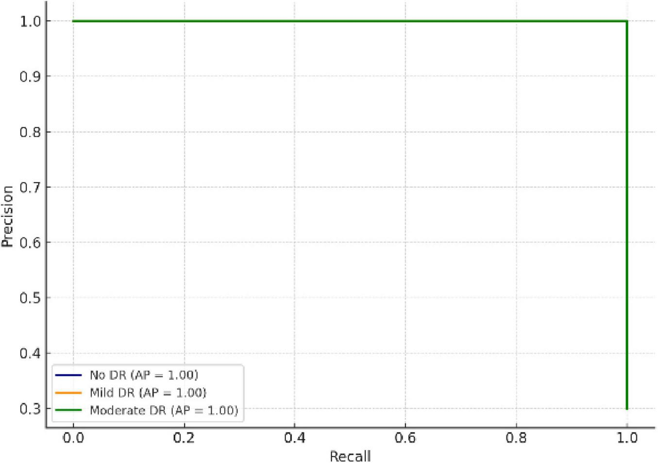 Precision-recall curve showing three lines representing No DR, Mild DR, and Moderate DR, all with an average precision (AP) of 1.00. The data points form a perfect right angle at Recall 1.0 and Precision 1.0.