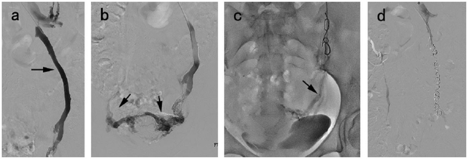 Four-panel grayscale medical imaging showing vascular structures. Panel a illustrates a prominent vessel with an arrow pointing to it. Panel b displays branching vessels with two arrows indicating specific locations. Panel c shows a partial X-ray view, with an arrow highlighting a specific area near the pelvis. Panel d depicts a coiled structure in a vessel, without arrows.