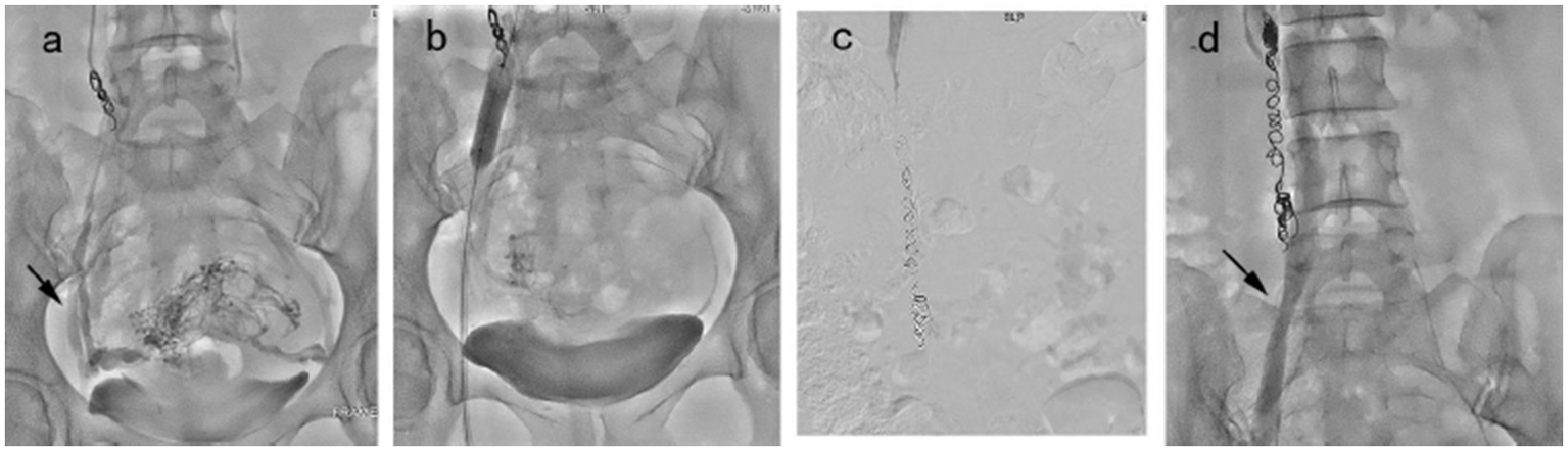 Four-panel grayscale medical image showing X-rays. Panel (a) indicates embolization with a coil in the pelvic area. Panel (b) shows post-embolization results. Panel (c) depicts an unprocessed fluoroscopic view. Panel (d) illustrates coil placement in the lumbar spine. Each panel is labeled with letters a to d.