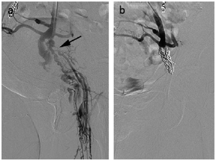 Two medical images show angiographic views. Image a shows a blood vessel with an arrow indicating a narrowed section. Image b shows the same vessel post-procedure, with a coil device placed for treatment.
