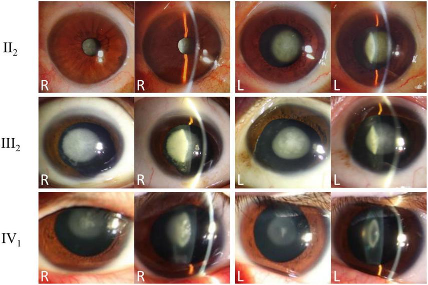 A set of twelve eye photographs arranged in three rows, each depicting right (R) and left (L) eyes with varying stages of cataract. The top row (II₂) shows eyes with small central lens opacities. The middle row (III₂) displays eyes with more pronounced opacities, affecting larger lens areas. The bottom row (IV₁) shows eyes with extensive lens opacities, significantly impacting visual clarity.