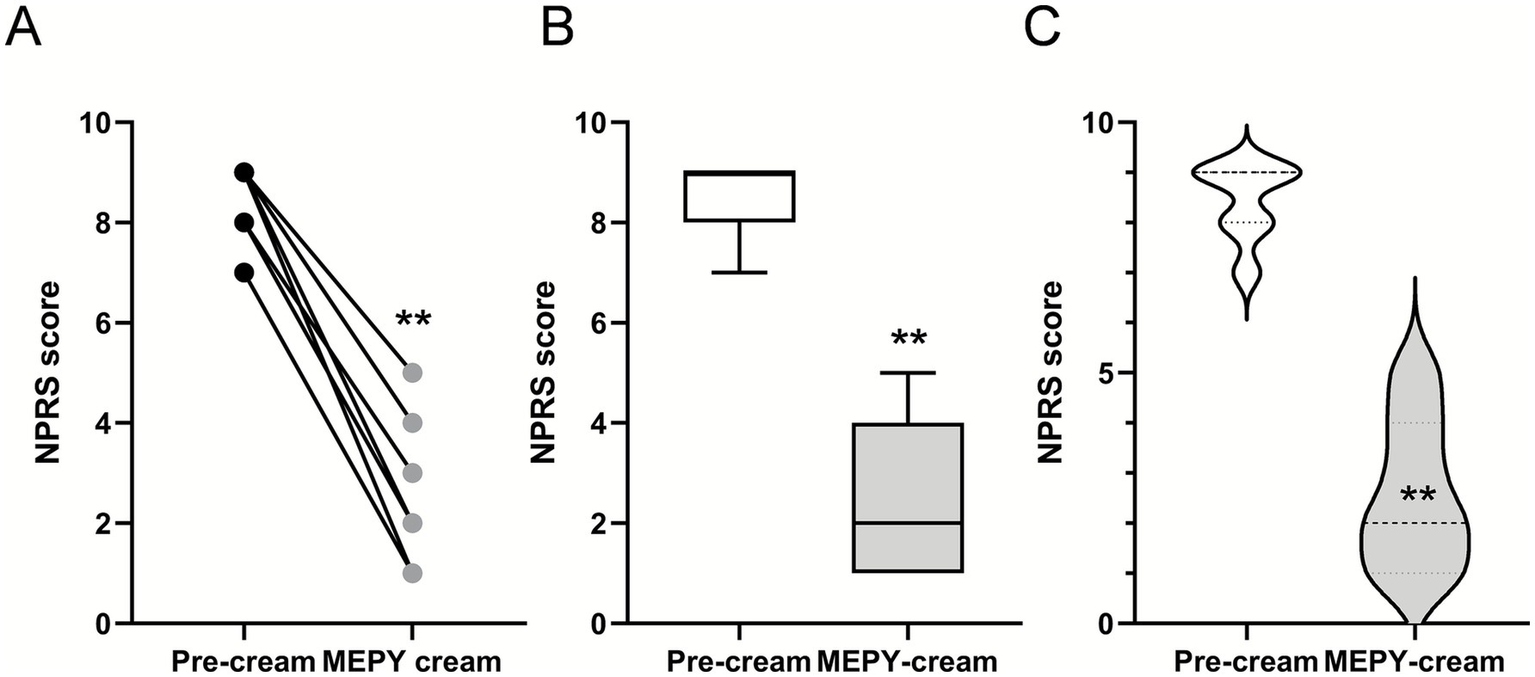 Graphs comparing NPRS scores for pre-cream and MEPY cream treatments. Panel A shows individual score changes with a significant decrease. Panel B presents a box plot, and Panel C features a violin plot, both indicating lower scores after treatment (** p < 0.01).