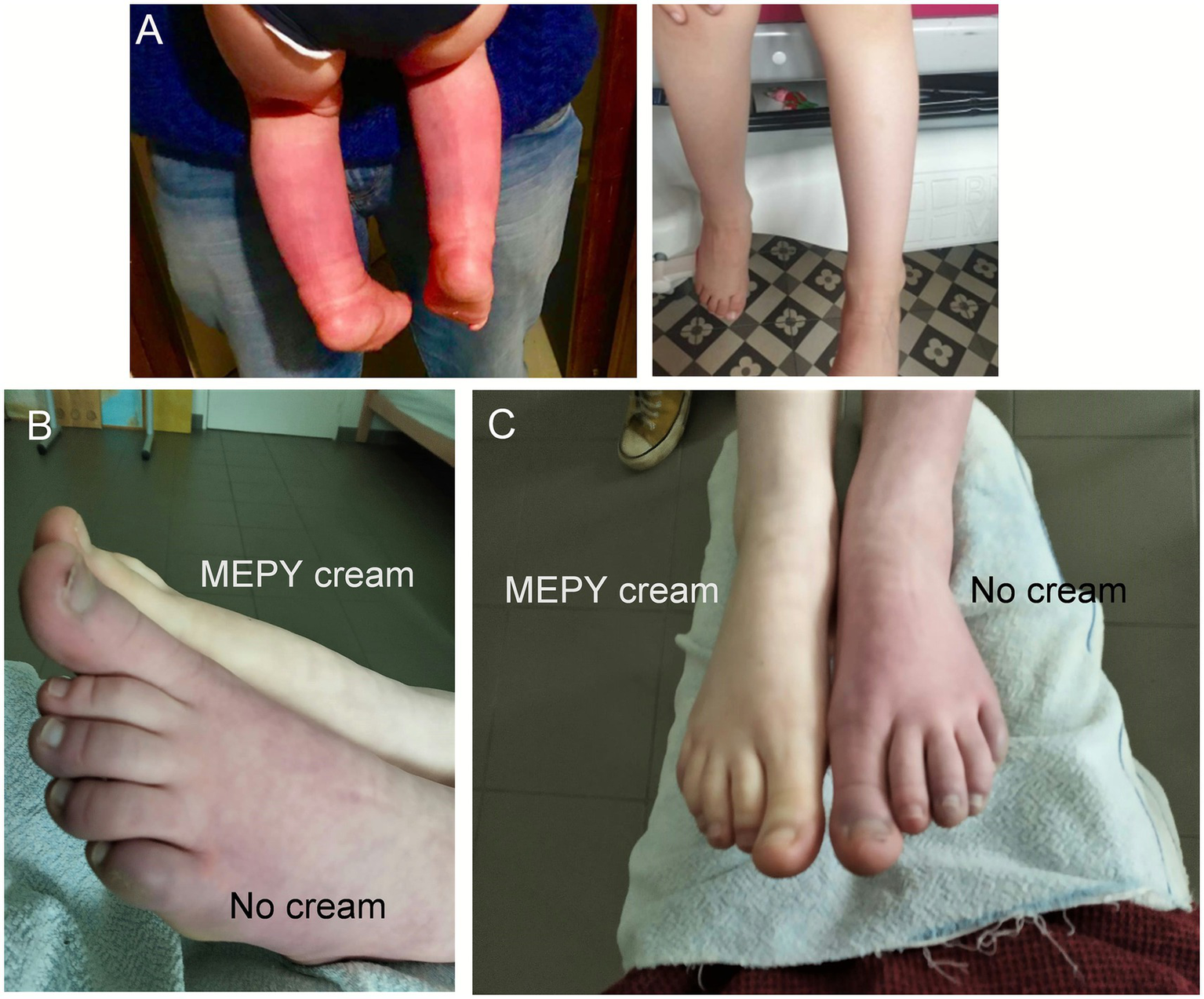 Collage showing four images of legs and feet. The top left shows a child’s reddish legs. Top right shows the child’s legs and feet with normal skin tone after mepyramine treatment. Bottom images compare feet treated with MEPY cream versus untreated; treated areas appear lighter, while untreated areas are red and irritated.