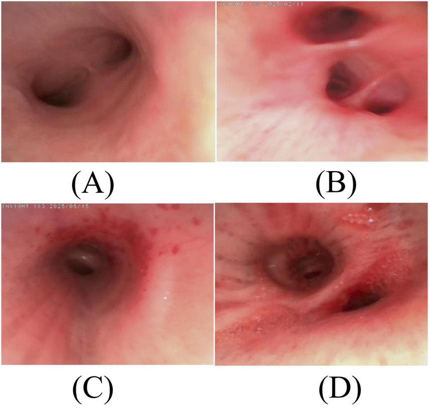 Four endoscopic images labeled A, B, C, and D show different views of an esophagus. Image A shows a normal esophagus with smooth walls. Image B depicts a narrowed esophagus with irregular surfaces. Image C shows slight redness and mild inflammation. Image D illustrates significant redness and severe inflammation.