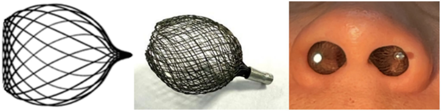 Illustration of a cylindrical wire mesh device on the left, a photo of the same device with a metallic tip in the center, and on the right, two similar devices inserted into a person's nostrils.