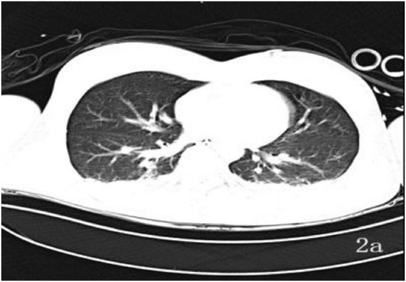 Axial chest CT scan showing cross-sectional view of both lungs and heart, displaying clear lung fields and normal branching of pulmonary vessels without visible abnormalities or opacities.