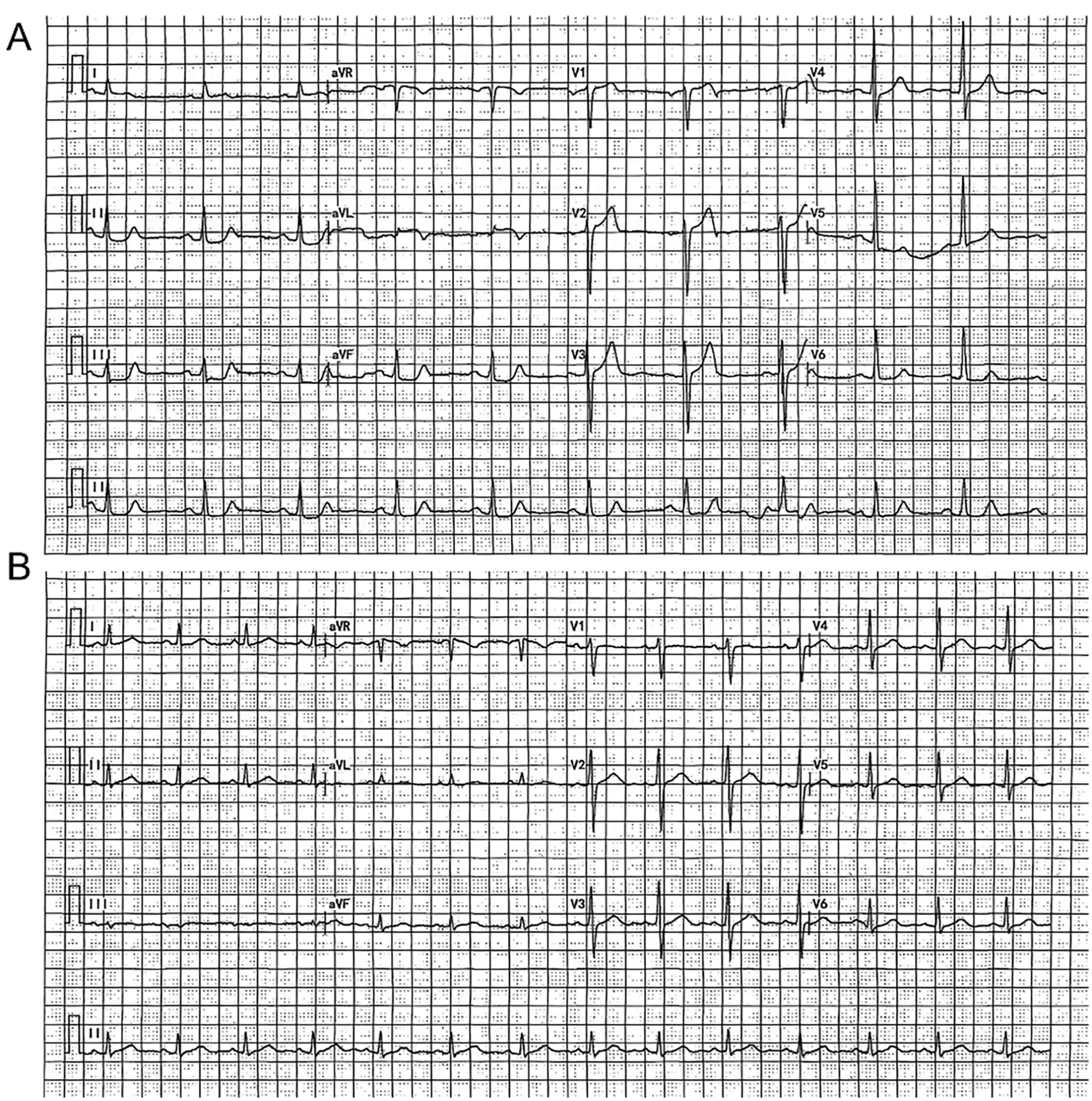 Two panels labeled A and B display electrocardiograms on a grid. Both panels show similar lead patterns labeled as I, II, III, aVR, aVL, aVF, V1 through V6, depicting heart rhythms. The waveforms on each lead indicate electrical activity variations.