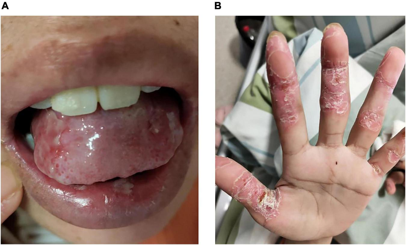 Panel A shows a close-up of a person’s mouth with visible inflammation and lesions on the tongue. Panel B depicts a hand with peeling and cracked skin, showing signs of a dermatological condition.