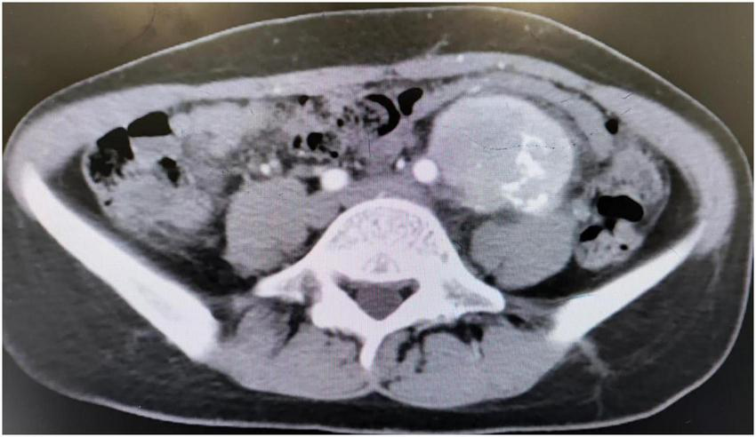 CT scan of the abdomen showing a cross-sectional view. A large mass is visible to the right of the spine, with varied shades indicating different tissue densities. The vertebra is in the center.