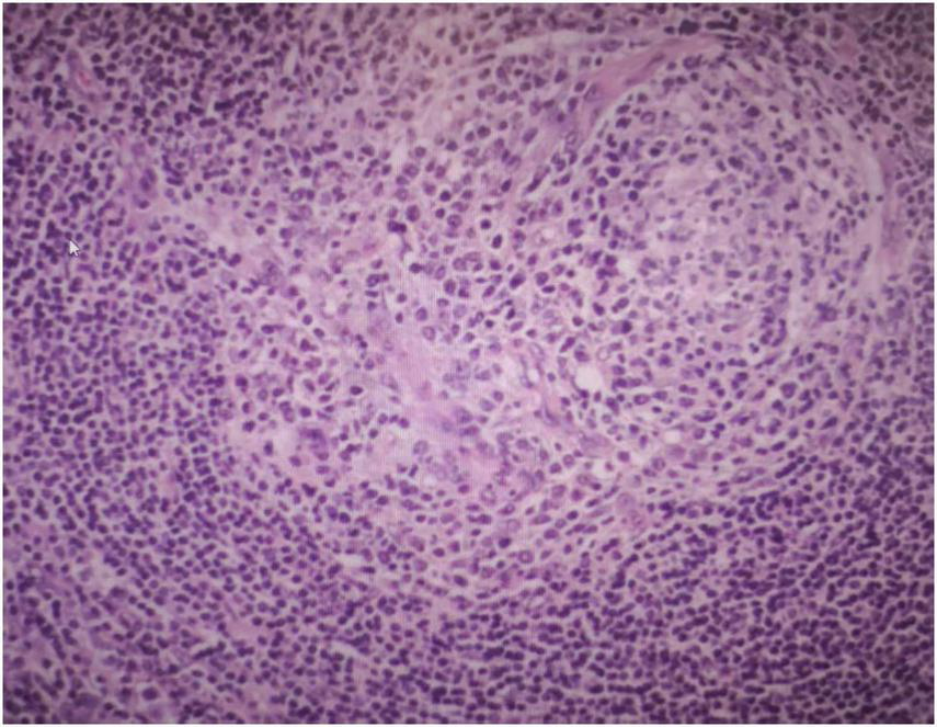 Microscopic view of tissue showing a dense cluster of small, round, purple-stained cells with a uniform appearance, indicative of lymphoma. The background is a lighter pink, suggesting a histological staining process.