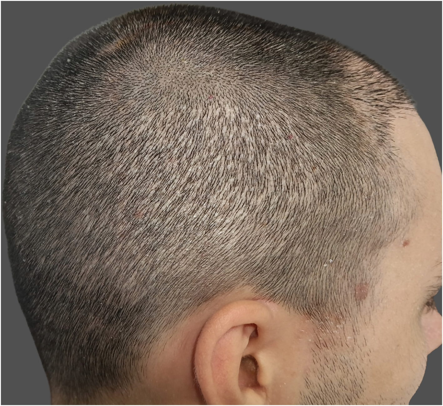 Lateral view of the scalp of a person with very short-cropped hair. In the lateral donor area, a clearly demarcated zone is visible where multiple small, round, lighter-colored spots are scattered across the scalp surface. These spots appear as tiny depigmented macules contrasting with the surrounding normally pigmented skin and correspond to follicular extraction sites, commonly referred to as pin-point white dots. The short hair length accentuates the visibility of these extraction-related skin changes.