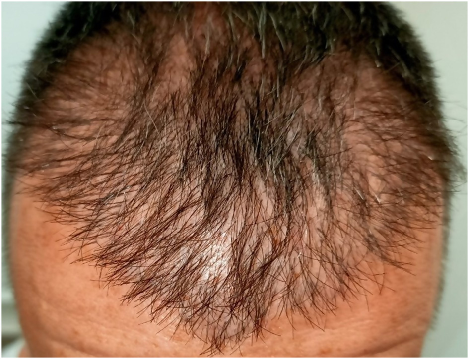 Frontal view of the recipient scalp showing an unnatural hair appearance. The transplanted area displays irregular hair direction and non-uniform orientation of the hair shafts, with visible scalp between grafts due to low hair density. The overall pattern appears uneven and contrasts with the surrounding native hair, highlighting the aesthetic impact of inaccurate graft angulation combined with insufficient density.