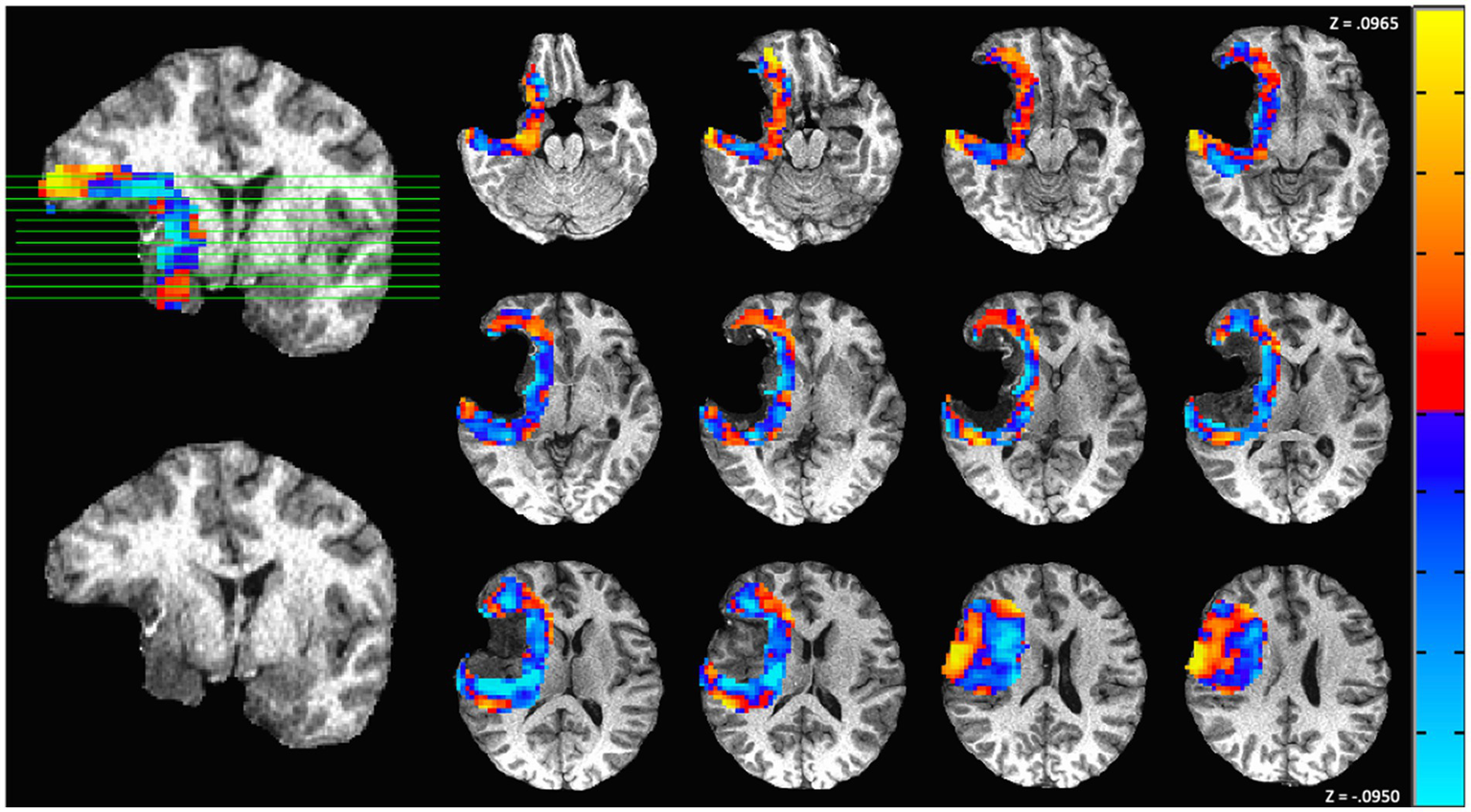 MRI brain scans showing multiple cross-sectional images highlighting areas of activation with color coding. The colors range from blue to red, indicating varying levels of activity or density, with a reference scale on the right.
