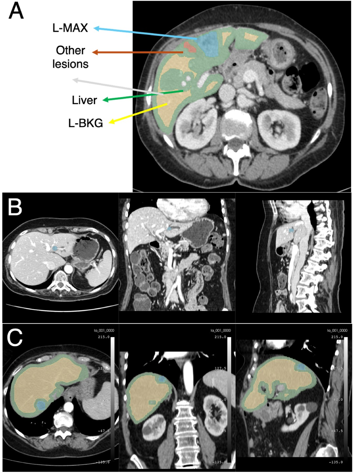 CT scan images in three sections labeled A, B, and C. Section A highlights various areas in the abdomen, with labels pointing to L-MAX, other lesions, liver, and L-BKG. Sections B and C provide different views of the liver with highlighted regions. These images are used for medical analysis of liver lesions.