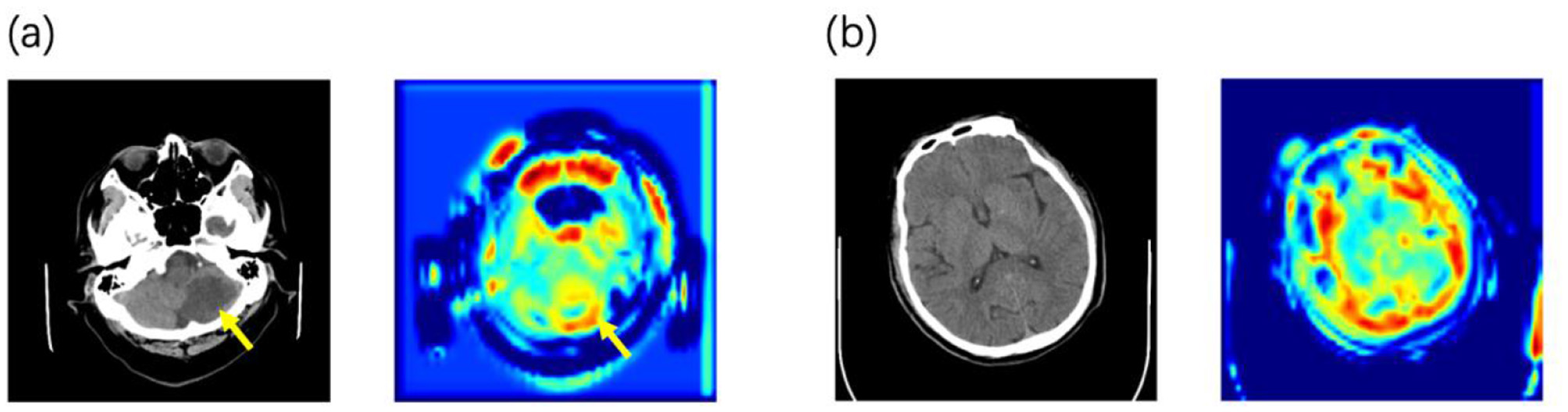 Panel (a) shows two images: a CT scan of the lower head with a yellow arrow pointing to an area, and a corresponding heat map with color variations. Panel (b) displays a CT scan of the upper head and a matching heat map, both without arrows.
