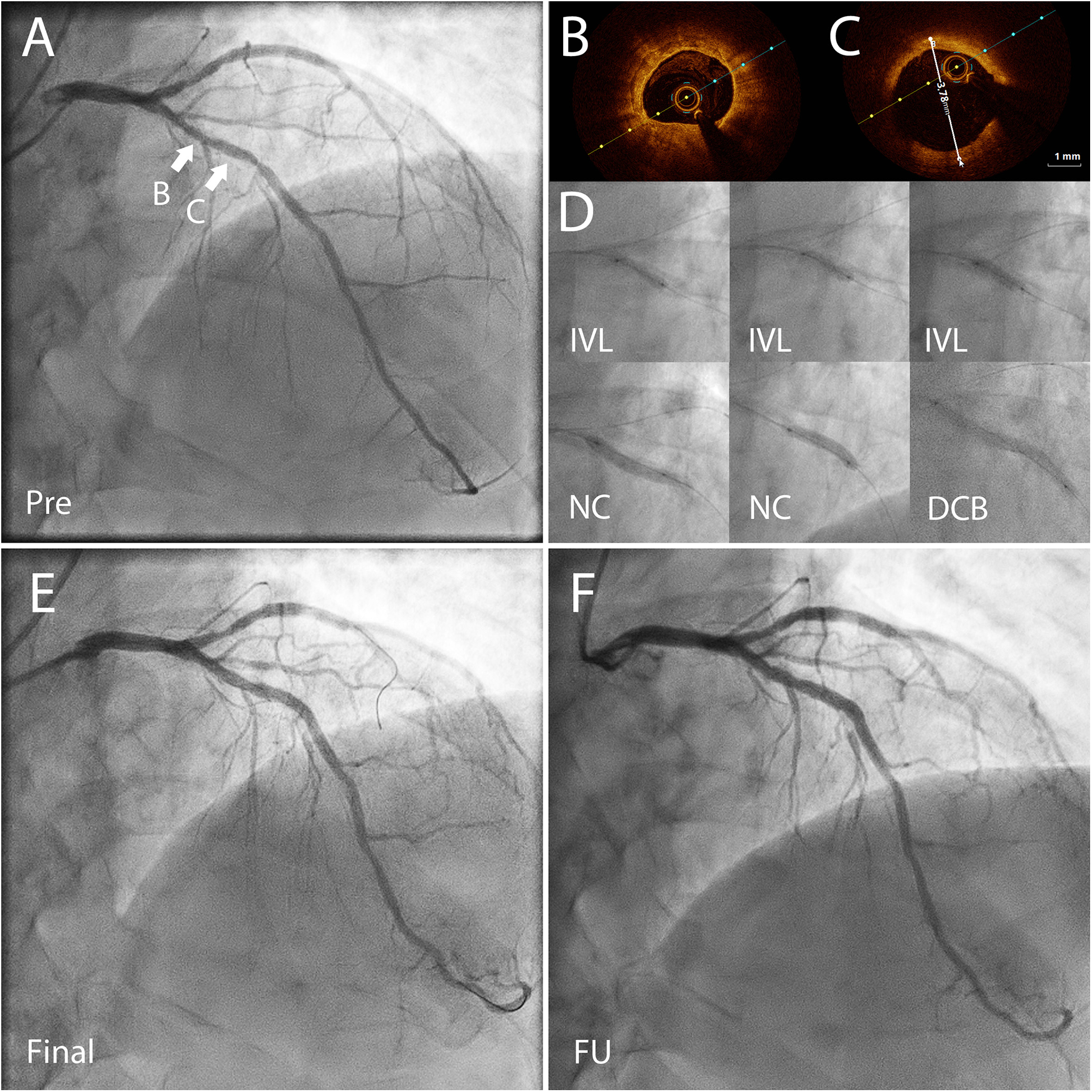 Medical imaging panel showing coronary angiography views in different stages: A) Pre-treatment, highlighting sections B and C; B and C) Pre-treatment OCT images; D) Detailed coronary angiography images labeled IVL, NC, and DCB depicting intervention stages; E) Final post-treatment view; F) Follow-up view illustrating good long term percutaneous intervention result.
