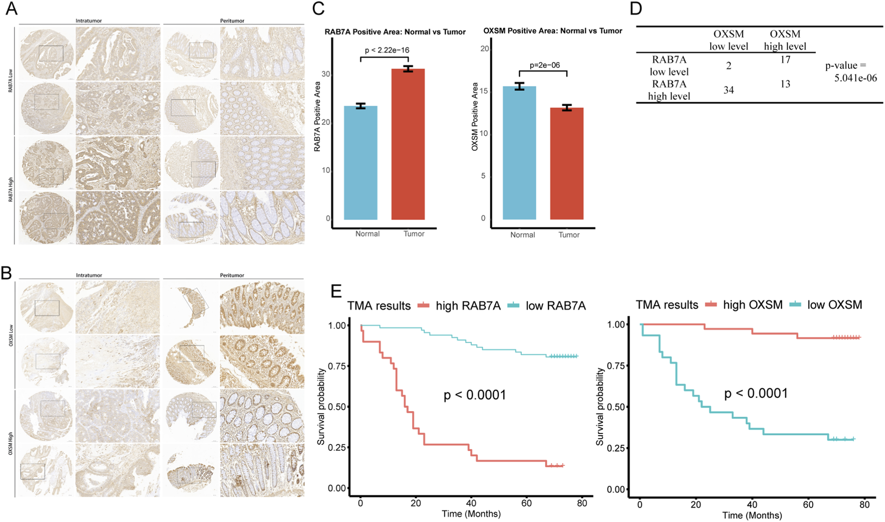 Composite image with five panels: A and B show microscopy images of intratumor and peritumor areas with varying RAB7A and OXSM levels. C displays bar graphs comparing RAB7A and OXSM positive areas between normal and tumor samples, showing significant differences. D is a table summarizing statistical data on OXSM and RAB7A levels. E includes two Kaplan-Meier survival curves, indicating that high RAB7A and OXSM levels correlate with lower survival probability.
