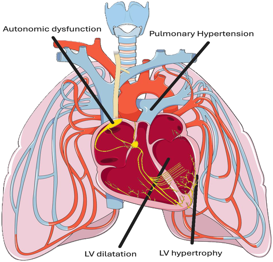 Illustration of the human heart and lungs affected by sickle cell related cardiomyopathy and cardiovascular autonomic dysfunction. Pathophysiological changes including left ventricular dilation, left ventricular hypertrophy, pulmonary hypertension and diastolic dysfunction.
