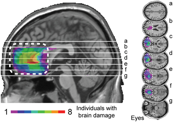 איור 3 - מפה חופפת עבור אנשים הסובלים מנזק מוחי בקליפת המוח הקדם-מצחית התמונה משמאל היא מבט על המוח מצידו השמאלי של הראש.