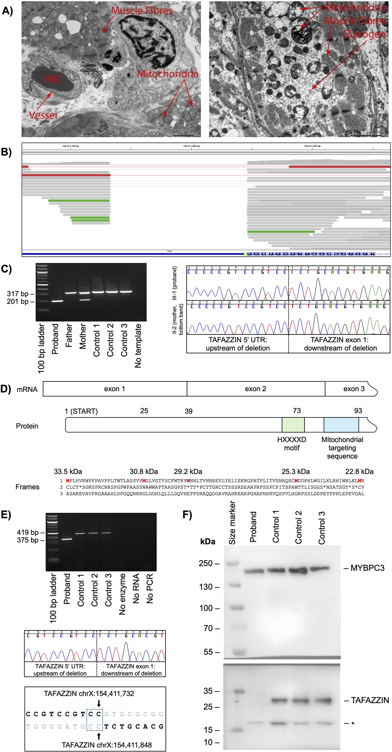 A) Two electron microscopy images showing muscle fibers, mitochondria, blood vessel, and glycogen with labeled annotations. B) DNA sequence alignment showing deletion in sample sequences. C) Gel electrophoresis results with DNA bands, accompanied by DNA sequence chromatograms highlighting regions upstream and downstream of deletion. D) Diagram of mRNA structure with exon and protein details, including in-frame methionine residues and molecular weights. E) Additional gel electrophoresis results with sequence chromatograms of TAFAZZIN gene, highlighting breakpoint junction. F) Western blot image showing protein expression levels of MYBPC3 and TAFAZZIN across various samples, with a size marker for reference.