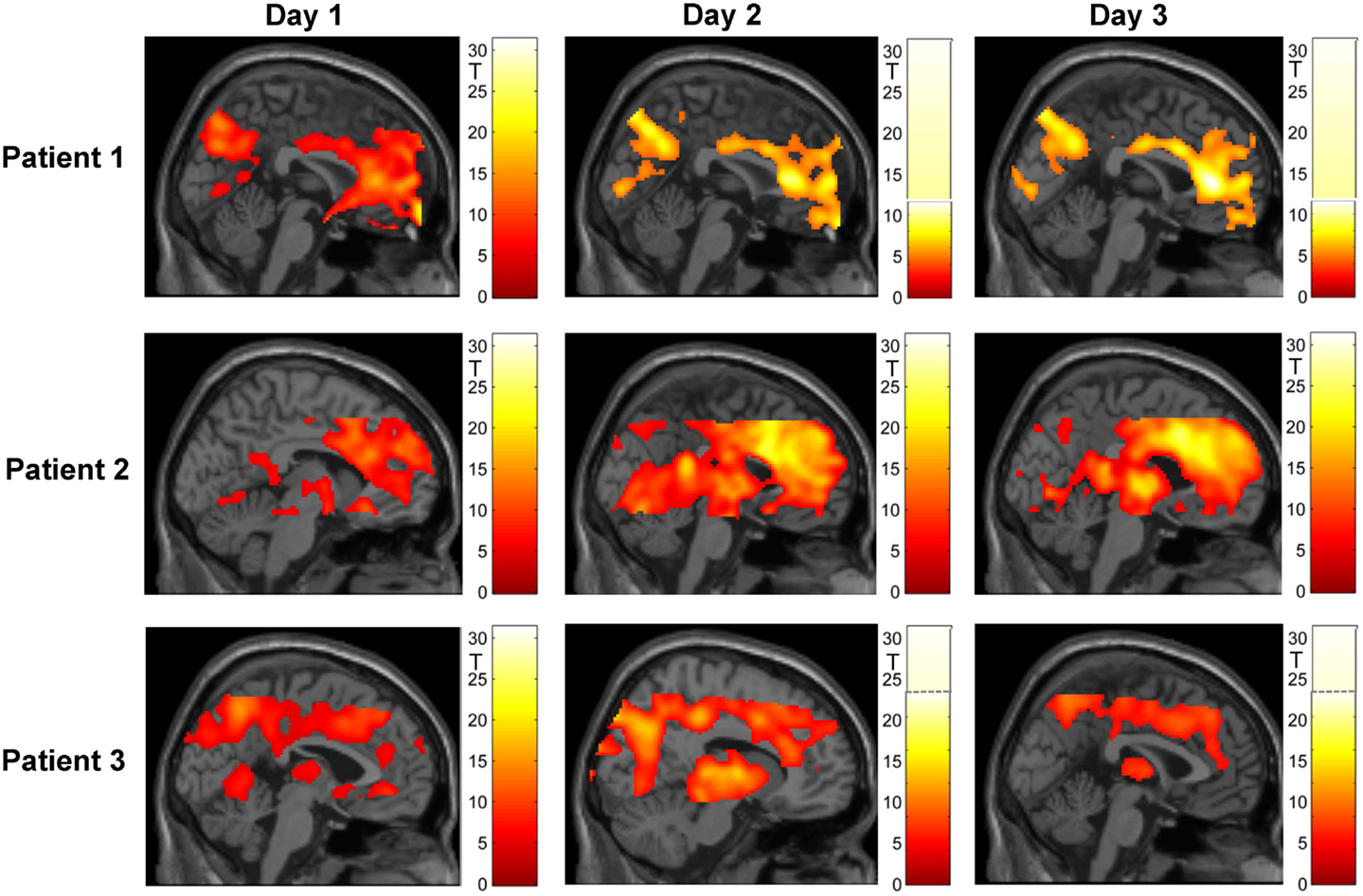 schizophrenia auditory hallucinations