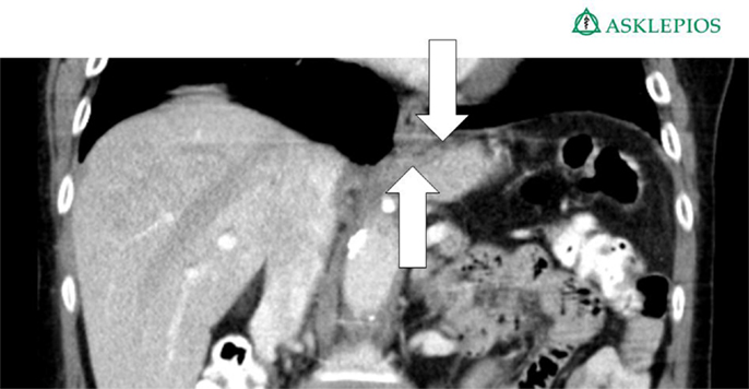 Frontiers | Functional Results after Repair of Large Hiatal Hernia by ...