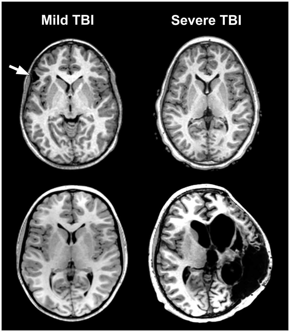 Trauma Brain Vs Normal Brain