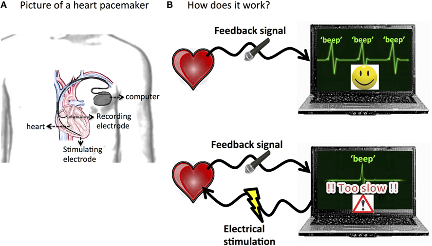 Figure 2 - Illustration of a heart pacemaker.