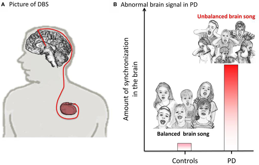 Figure 3 - Illustration of a brain pacemaker (DBS).