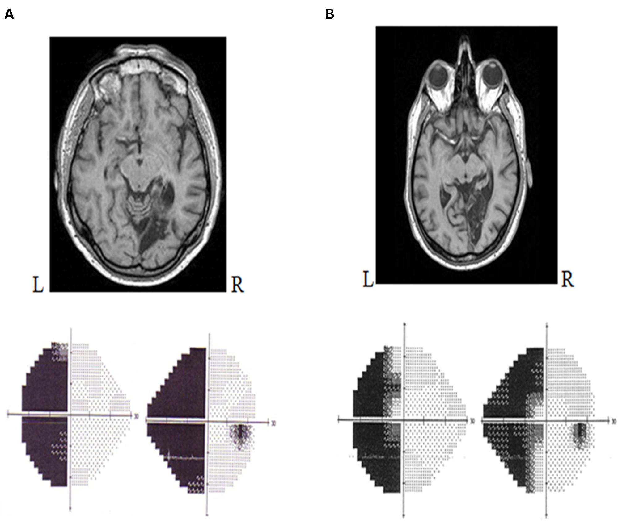 Frontiers | Behavioral Consequences and Cortical Reorganization in ...
