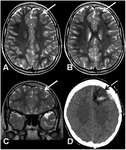 Frontiers | \u03949-THC Intoxication by Cannabidiol-Enriched Cannabis ...