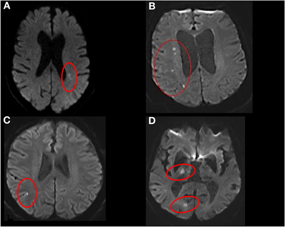 Frontiers | Examining Subcortical Infarcts in the Era of ...