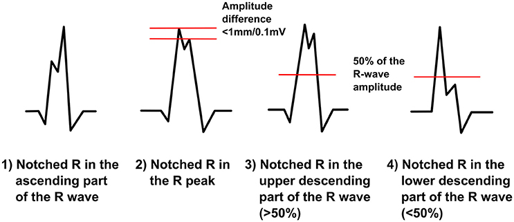 Frontiers | QRS Fragmentation Patterns Representing Myocardial Scar ...