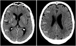 Frontiers | A Critical Review of Alberta Stroke Program Early CT Score ...
