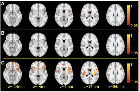 PDF) Are oxidative stress markers useful to distinguish schizoaffective disorder from schizophrenia and bipolar disorder?