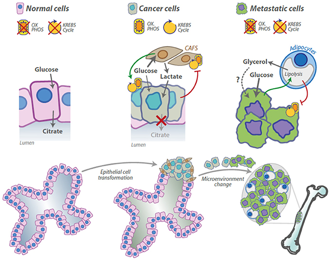 metastatic cancer glucose