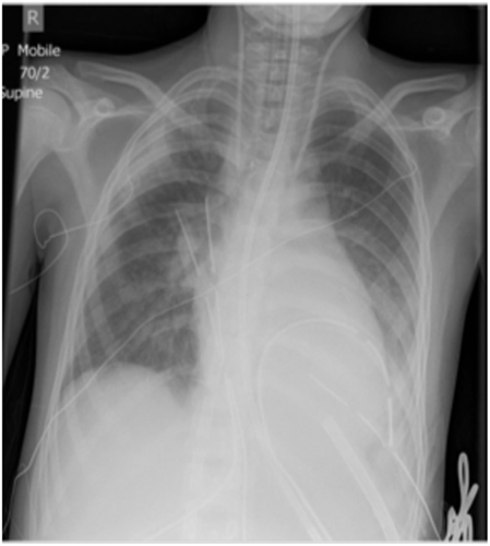 Frontiers | Cannulation for Neonatal and Pediatric Extracorporeal Membrane Oxygenation for ...