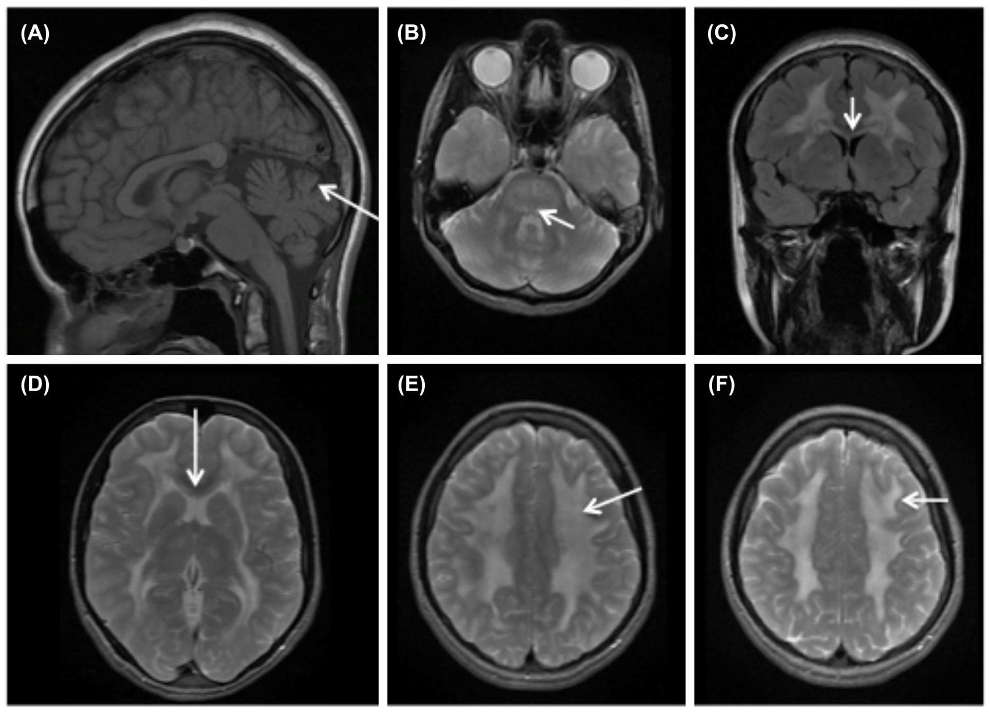 Frontiers Mitochondrial Neurogastrointestinal Encephalomyopathy