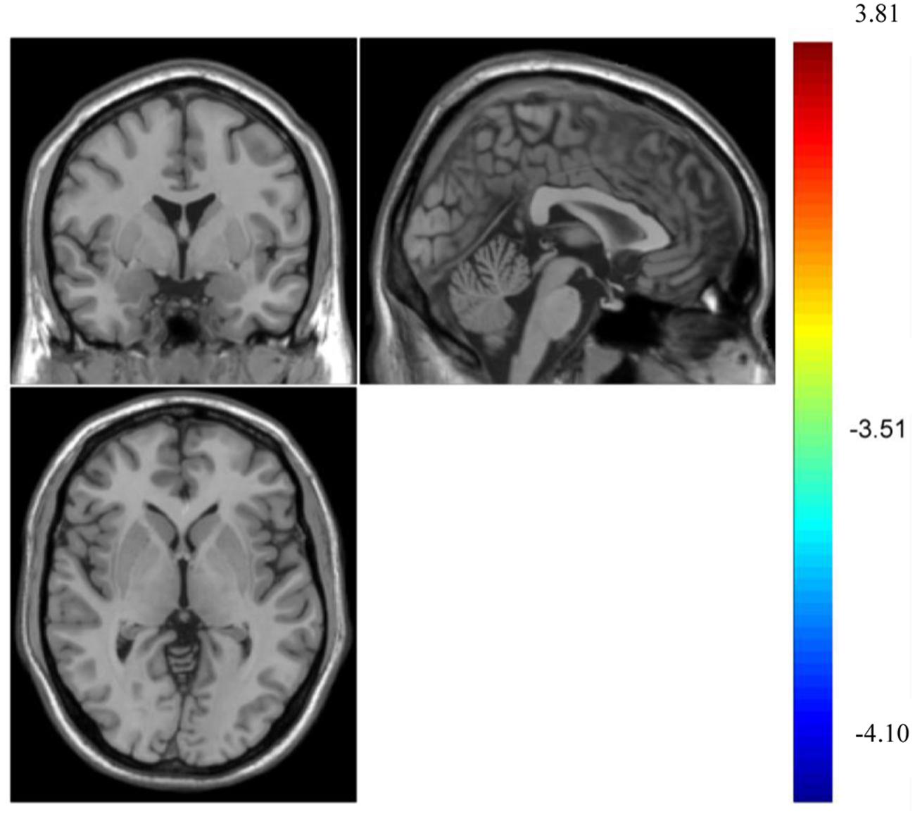 Frontiers  Spontaneous Brain Activity Did Not Show the Effect of