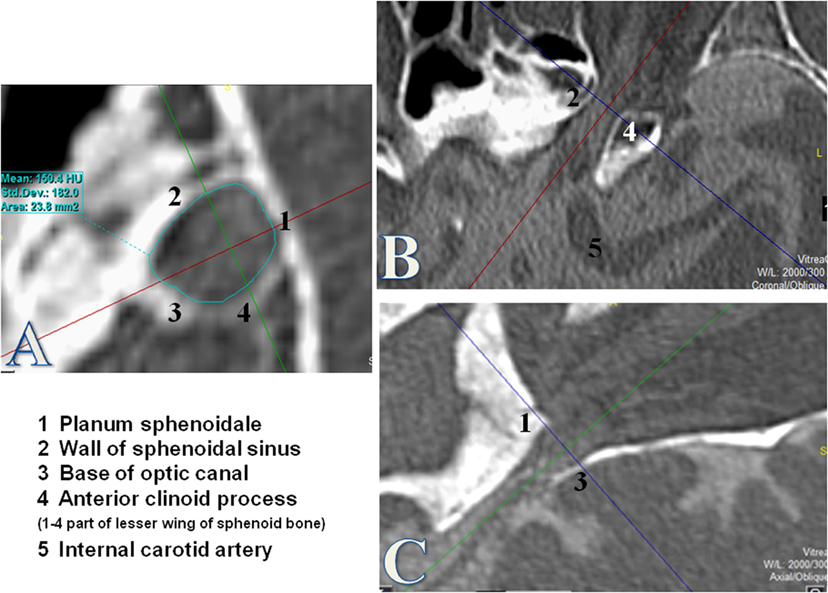 Canal Foramen, Fissure, Space & Membrane 読影の手立てとなる
