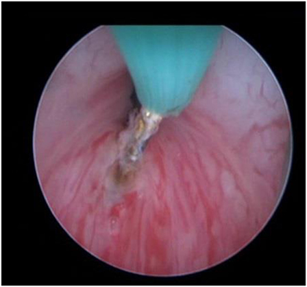 Bladder Neck Incision (B.N.I.) and Urethrotomy